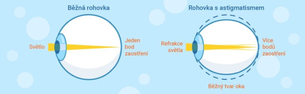 astigmatismus