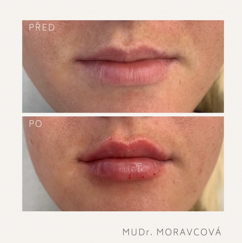 Krásné rty nejen na Valentýna