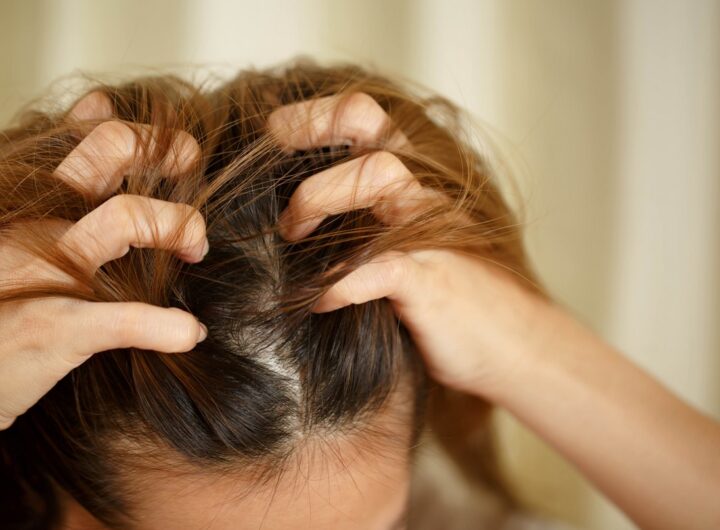 lupy, Seborea, dermatitida, kosmetika, vlasy, zdraví,