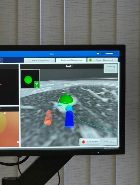 rakoviny plic, Prognóza, rakovina plic, zdraví