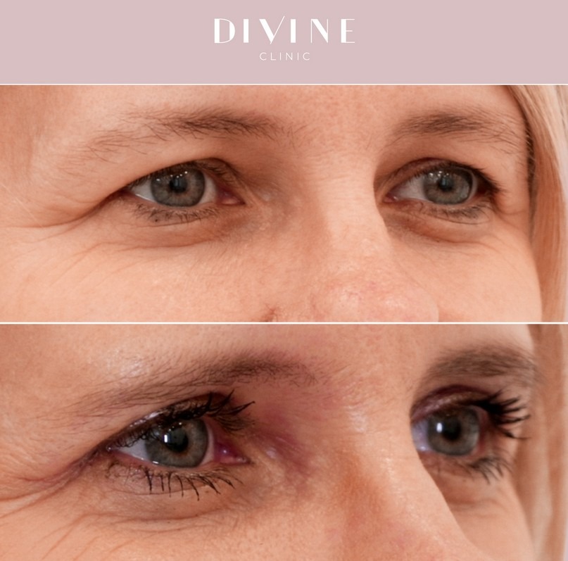 Operace horních víček, Be Divine, MUDr. Petra Moravcová