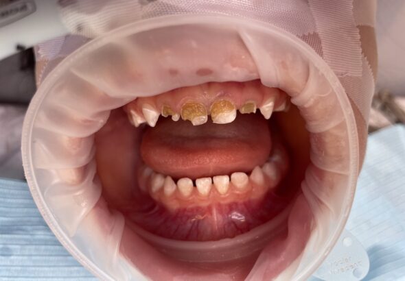 zub , čistý zub, Dětský úsměv, MUDr. Pavl Smažík